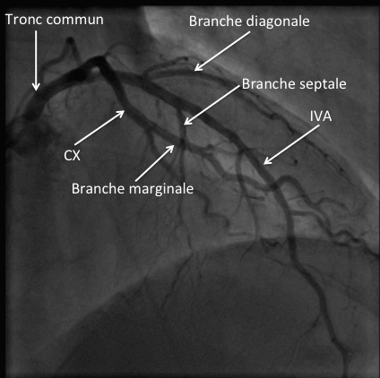 anatomie coronaires coeur