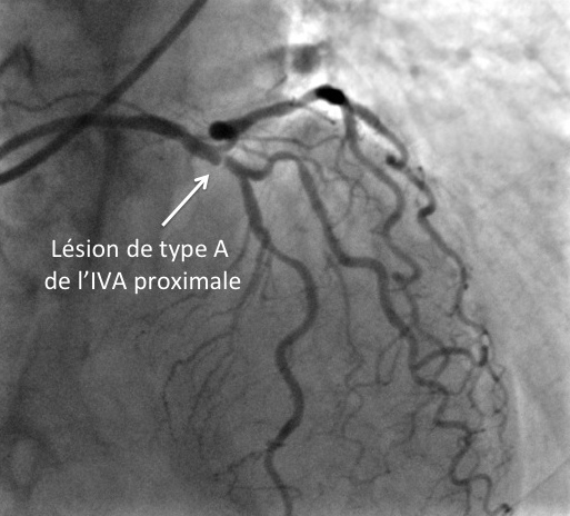 Classifications Aspects Anatomiques Des Lesions Flux Timi Classification Medina